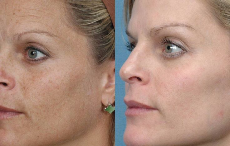 Before & After